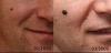 220px-NodularMelanomaEvolution.jpg